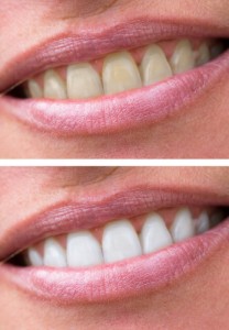 10-reasons-why-teeth-darken-and-discolor