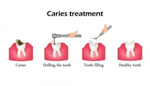 All About Dental Fillings