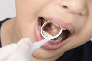 Are Dental Sealants Safe