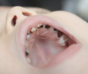 A view of a toddler's mouth that has lots of cavities in it. 