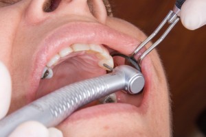 Close-up view of a person's mouth with cavities and fillings in it and he is receiving another cavity fill. 