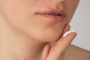 Herpes sore with pus on the lips of the young beautiful girl and a white cream on her finger