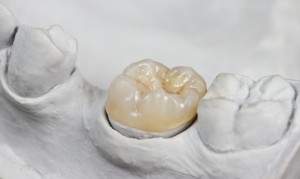 A dental crown resting on a dental model of the molars.