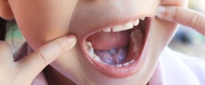 Early Childhood Tooth Decay - Is Your Child at Risk