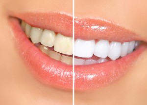 A close-up view of a mouth that has yellow teeth before teeth whitening and then newly-whitened teeth.