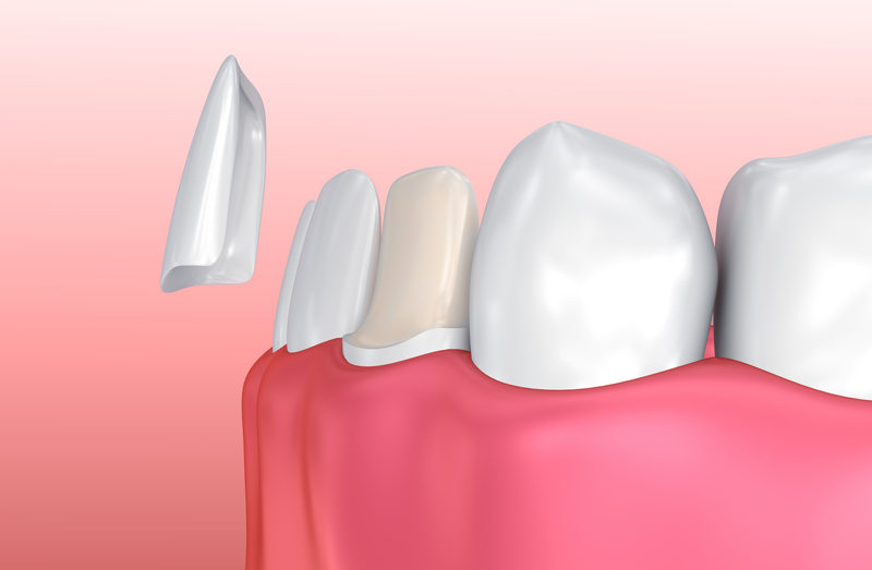 Illustration of how a dental veneer is fitted onto a tooth.