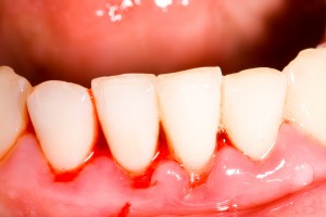 Very close-up view of a person's four front teeth with gum disease in their gums.