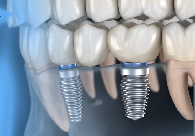 Picture of a dental bridge supported by a dental implant.