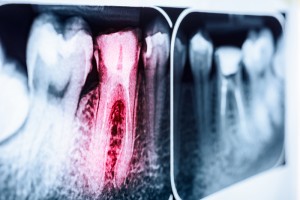 Dental x-rays of a root canal.