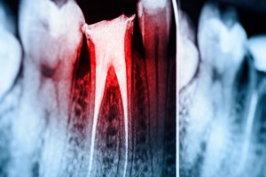 An x-ray image that shows a tooth that has received a root canal. 