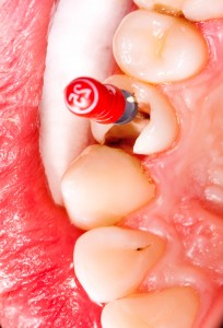 A close-up view of a tooth that has a root canal brush in it that is used in a root canal.