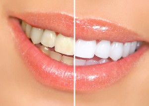 Teeth Whitening in Parker