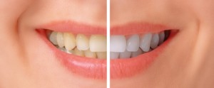Tooth Whitening Options_01
