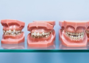 Orthodontist Treatment Options for an Overbite