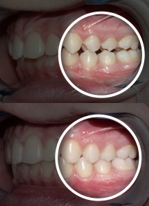 dentistry, malocclusion, after, before, cosmetic, occlusion, orthodontics, dental care, teeth, smile, mouth, treatment, dentists